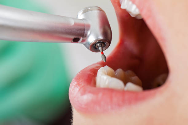 Best Urgent Care for Lost Fillings or Crowns in Bethel, WA
